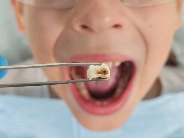 Best Emergency Dental Care for Broken or Chipped Teeth in Fair Oaks, VA